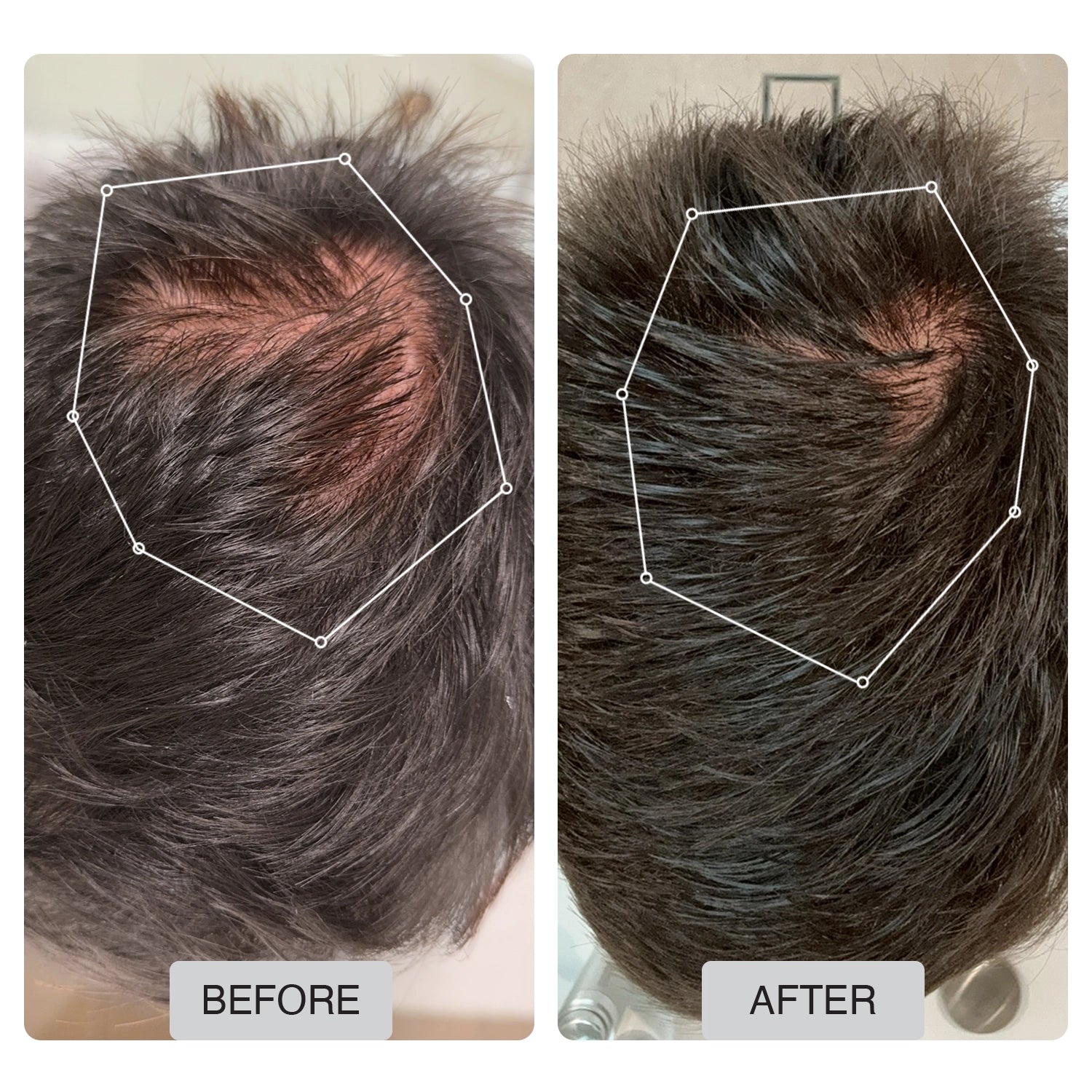Spectrum 312 Laser Hair Regrowth Cap