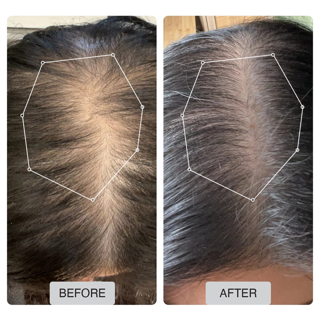 Spectrum 312 Laser Hair Regrowth Cap