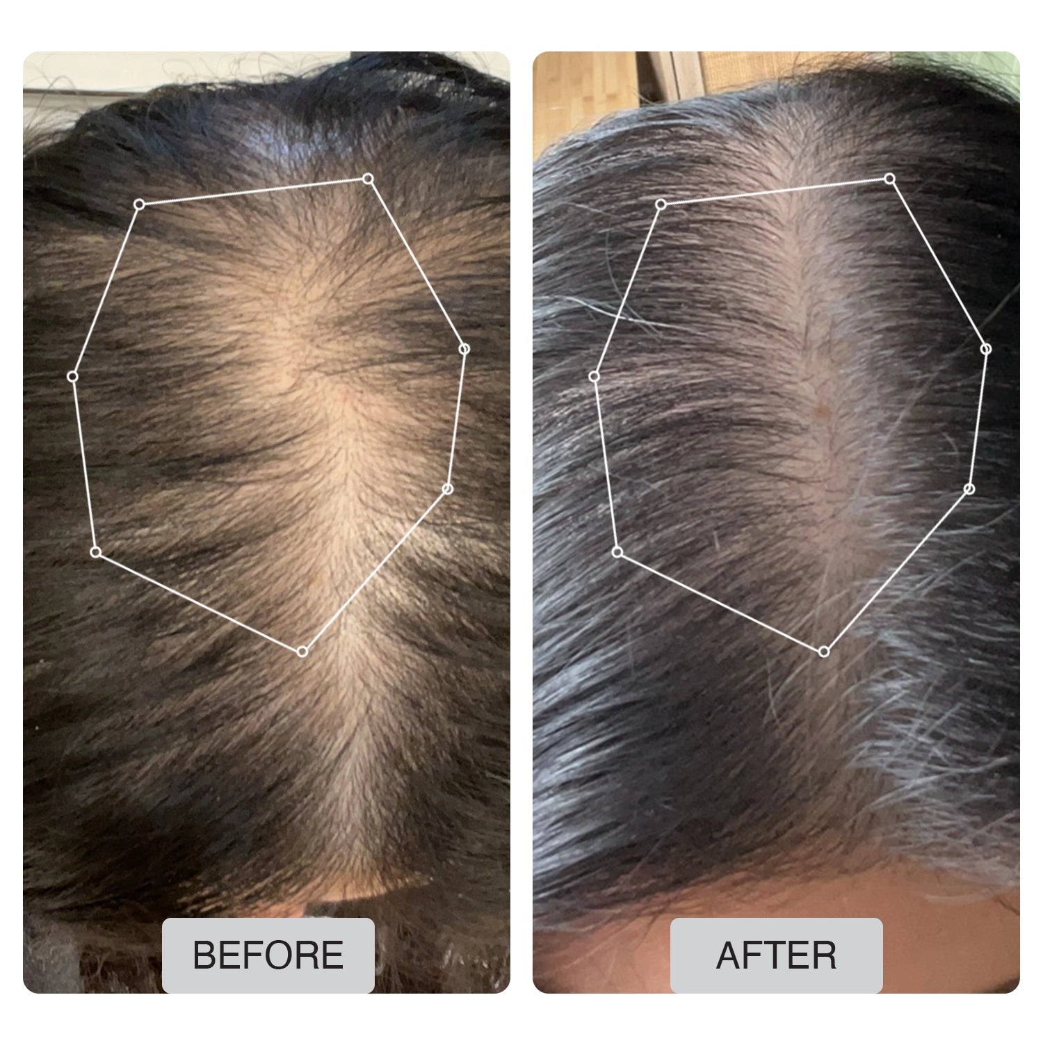 Spectrum 312 Laser Hair Regrowth Cap